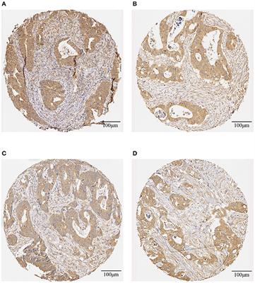 Image-Based Network Analysis of DNp73 Expression by Immunohistochemistry in Rectal Cancer Patients